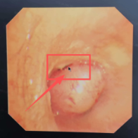 湖南医生为出生仅7天、重3公斤新生儿精准切除堵塞气道超五分之四肿物