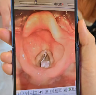 8个月宝宝险窒息！一片药板锡箔纸，卡住“生命气道”