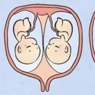 双胎妊娠，一个不得不告别，她们用最安全的方式保住了另一个