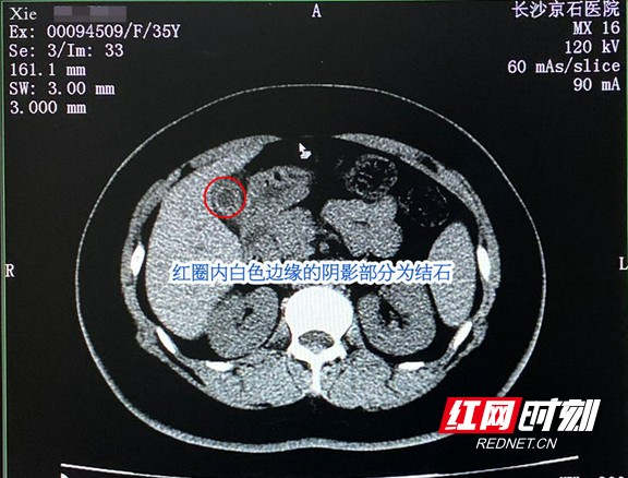 女子与家人团聚开心涮火锅 谁知引爆结石把自己"吃"进了医院
