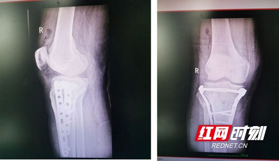 男子高处坠落致 粉碎性骨折 医护精心关爱助其康复出院