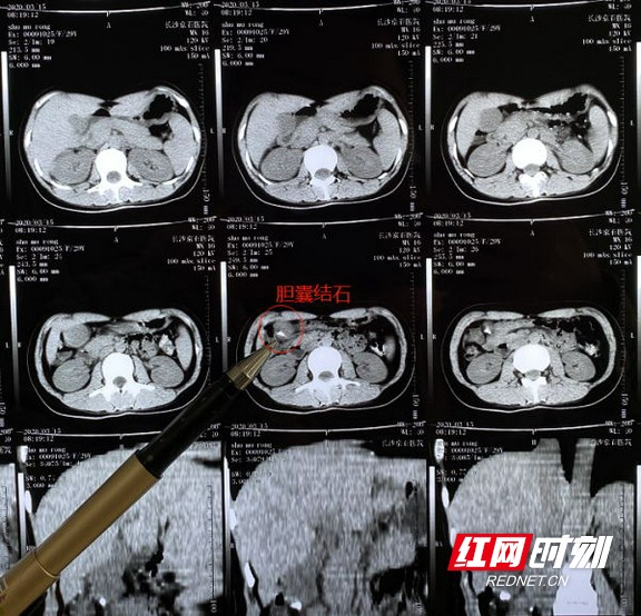 胆管结石片子图片