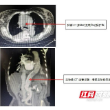 CT筛查出的“定时炸弹”