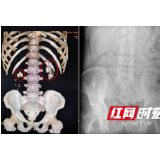 一天一斤酒致双肾塞满结石 医生妙手一次取净