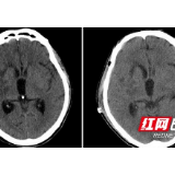 开颅术后不当“钢铁侠” 取下颅骨植入腹部“保鲜”再“回填”