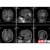 头痛以为高血压 警惕“脑瘤”在作怪