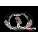 吃鱼汤泡饭后胸痛以为心脏病发 鱼刺戳穿食管险开胸