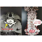 “钥匙孔”微创手术 成功解除教师10年顽固疼痛