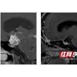 视力下降看眼科？专家提醒真凶可能是脑肿瘤
