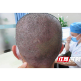 专家：克服心理障碍 正确认识银屑病
