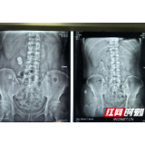 男子患肾结石拖延八年 “小绿豆”变成“大核桃”险毁一肾