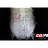 男子反复腰部疼痛不见好转 就医检查后发现肾险些“坏”了