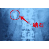 网瘾“满哥”长期熬夜吃宵夜 两年熬出肾脏“宝石”