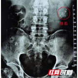 老汉结石缠身半辈子 20年行15次结石手术