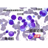 40岁男子腰腿疼 骨髓穿刺竟是骨髓瘤