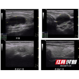 甲状腺长结节怎么办 不开刀的消融术来帮忙