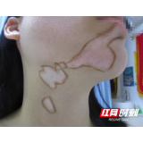 女子面临毕业压力大 缺乏锻炼致白斑扩散