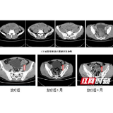 湘雅常德医院实施全腹腔放疗治疗促纤维增生性小圆细胞肿瘤