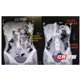 “院长信箱”架起医患连心桥：患儿国内就医 慈母越南致谢