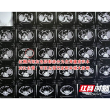 贵州大叔因肾结石左腹留20厘米疤 如今又面临切肾风险