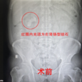男子腰胀腰痛误以为劳累所致 突发剧痛入院发现肾结石危机