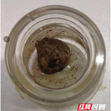 运动达人查出“老结石” 专家提醒：定期体检不能忽视