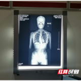15岁少女弯腰驼背 被诊断为脊柱侧弯 这些不良习惯要改