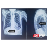 癌痛患者福音 三真康复成功开展鞘内吗啡泵置入技术