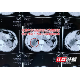 男子半夜腰痛得直打滚 紧急就医才知是结石在作怪