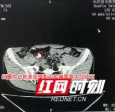 男子发现肾结石想自排 剧痛后就医发现酿成大祸