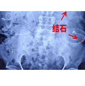 “无创取石”遇尿路改道U型扭曲 医生攻克高难度手术