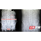 男子常年腰痛不理会 近日症状加剧查出背后“真相”