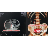 30年结石老病号不痛不管 入职体检才发现肾脏陷入危机
