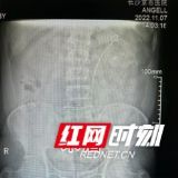 男子5年间2次被肾结石找上门 原因竟和这个习惯有关