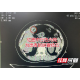 女子发现结石误信“偏方”拖延2年致胆囊萎缩遗憾切胆