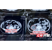 男子腹痛整晚急就医 才知竟是颗花生米大的结石在作怪