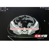 男子吃药排石2个月 未料结石“纹丝不动”反致肾脏危机