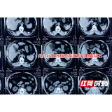 男子聚餐大吃大喝引爆胆囊结石 腹痛半年的原因竟是它