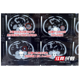 男子多次尿血却忽视 突发剧痛就医才知花生大结石卡住输尿管