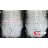 男子突发腰痛就医 才知小结石5年间竟增大6倍