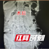 七旬娭毑频繁尿血不愿就医 检查发现膀胱有颗“鸡蛋大结石”