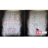 男子左肾结石大如生姜？ 医生：这些结石诱因要警惕