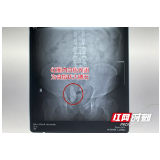 32岁汽修工输尿管长出“食指状”大结石 医生:实属罕见