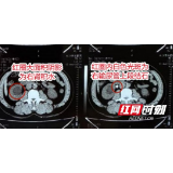 男子酒后腹痛不止还尿不出来 就医才知竟是结石惹得“祸”