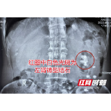 男子结石一忍二十年 如今“扎根”肾脏长成生姜状险毁肾
