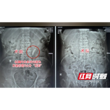 六旬嗲嗲偶然体检惊现“石街” 原来与这个习惯有关