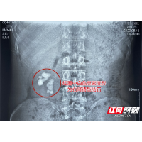 大叔患肾结石不痛不治 未料10年后“小豆子”变“石头山”