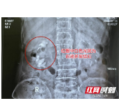 娭毑频繁腰痛、尿血 就医才知右肾长出4.5厘米“西蓝花”