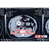 朋友因胆囊结石引发胆囊癌 “带石”多年的她急忙就医