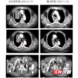 湖南省肿瘤医院：临床试验让晚期肺癌患者获益
